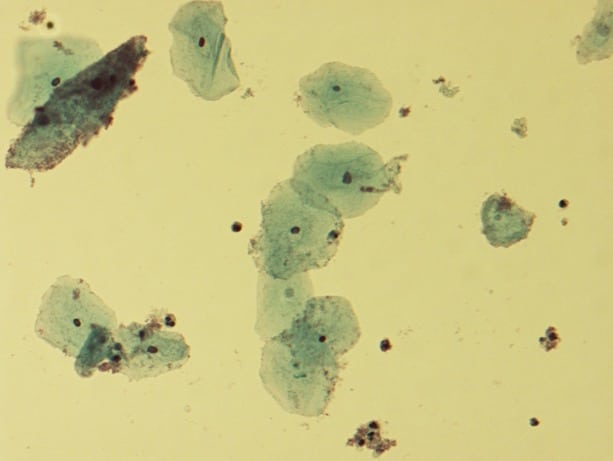 Microscopic picture of vaginal epithelial clue cells coated with Gardnerella vaginalis, magnified 400 times.